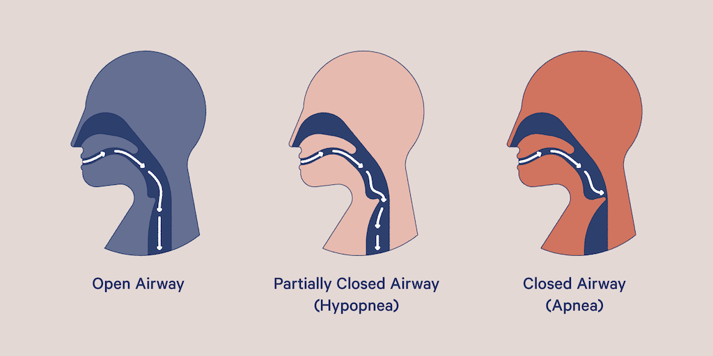 complex sleep apnea